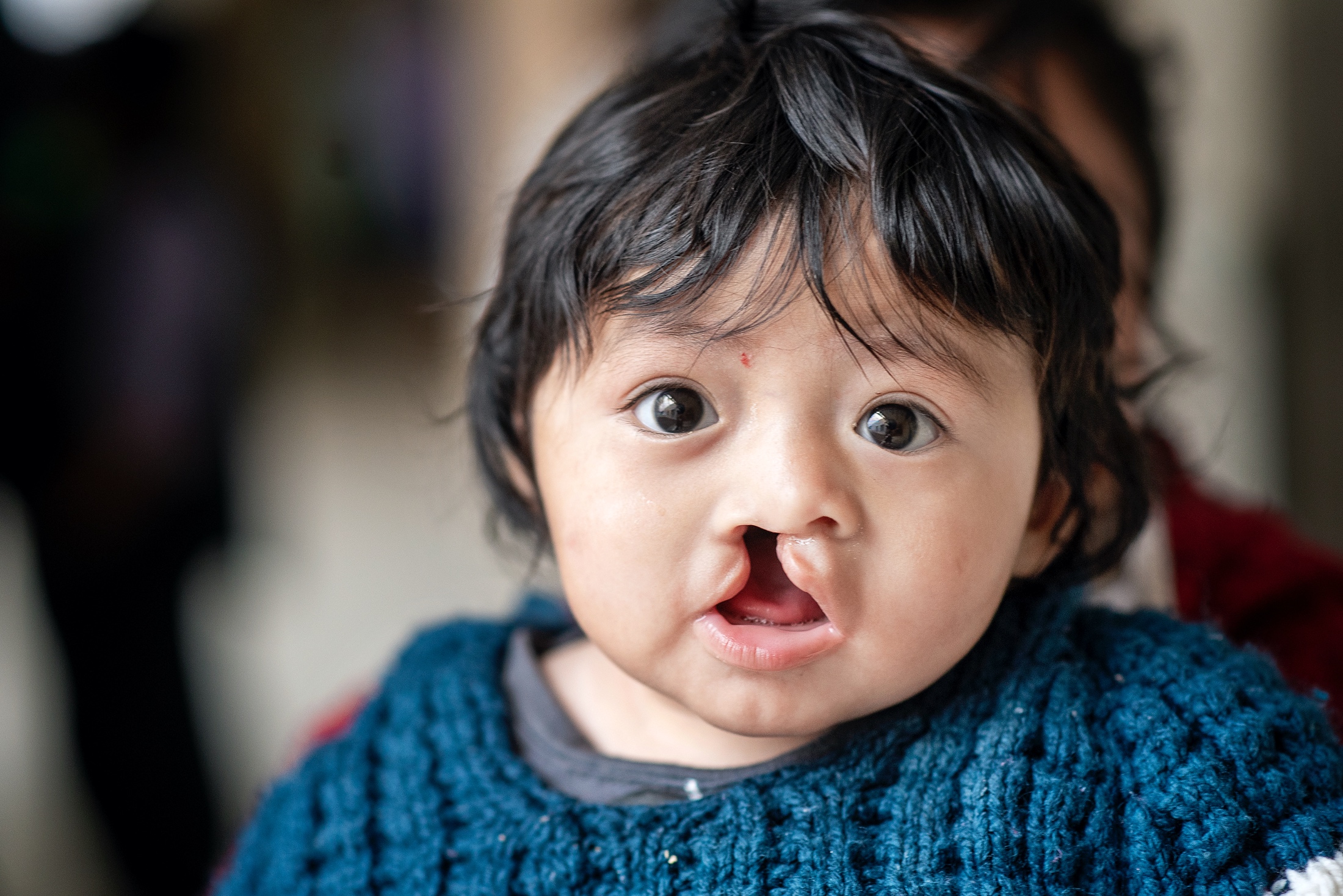 A child with cleft lip