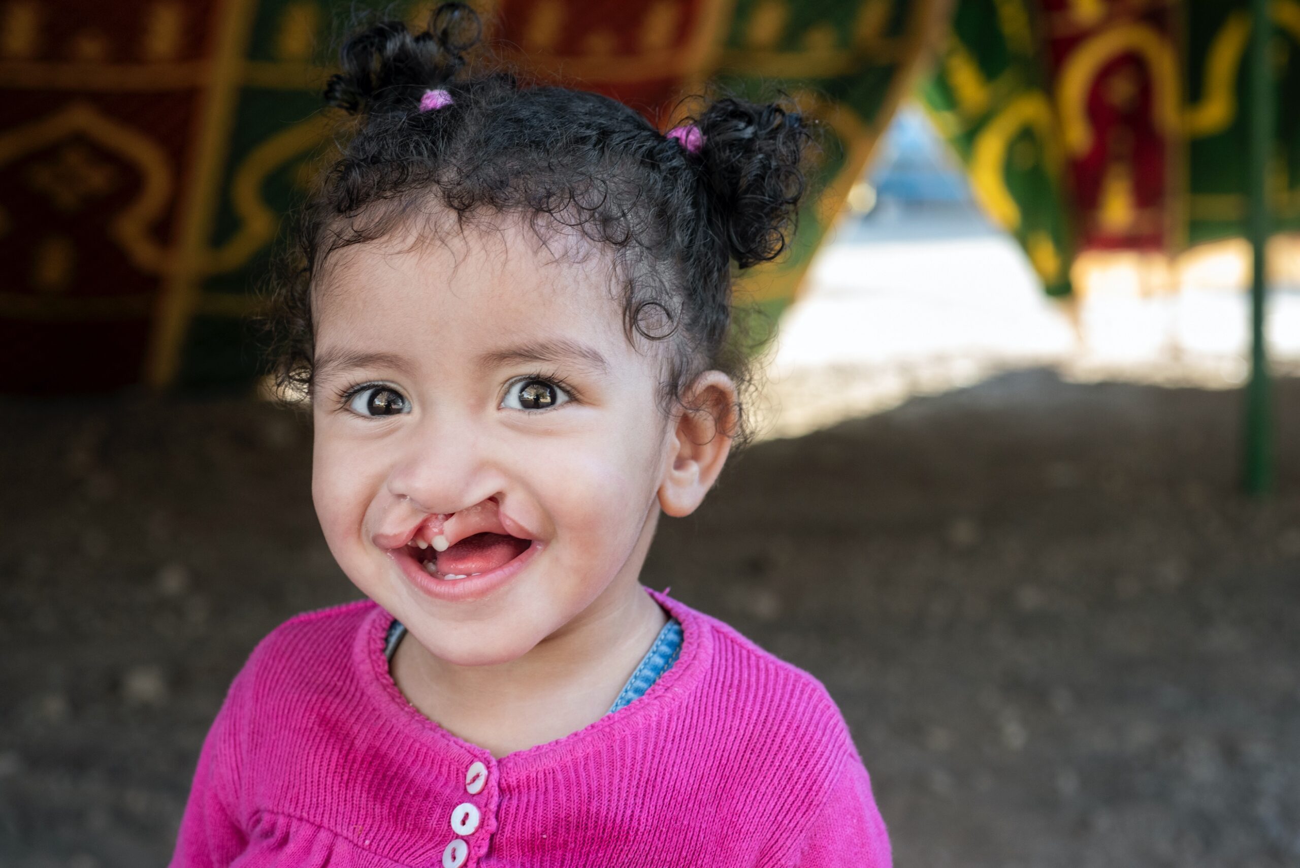 A child with cleft lip