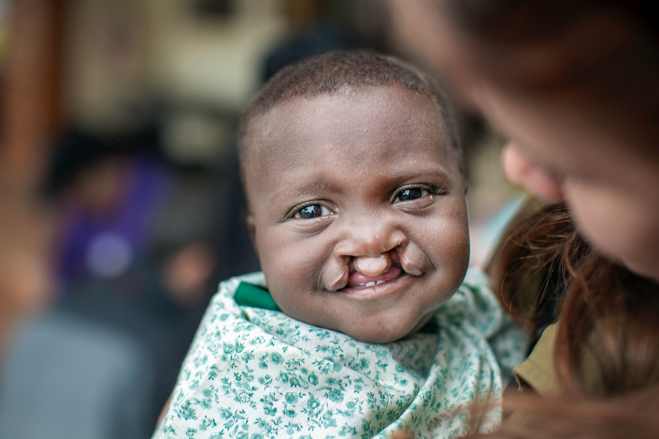 A child with cleft lip