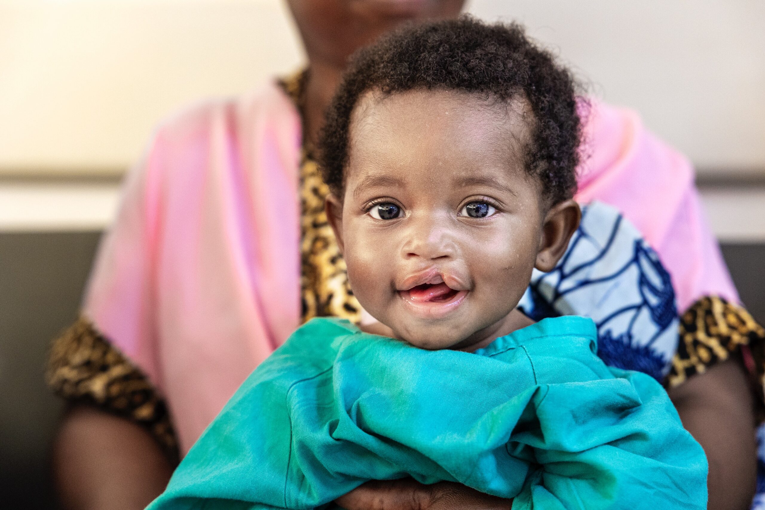A child with cleft lip